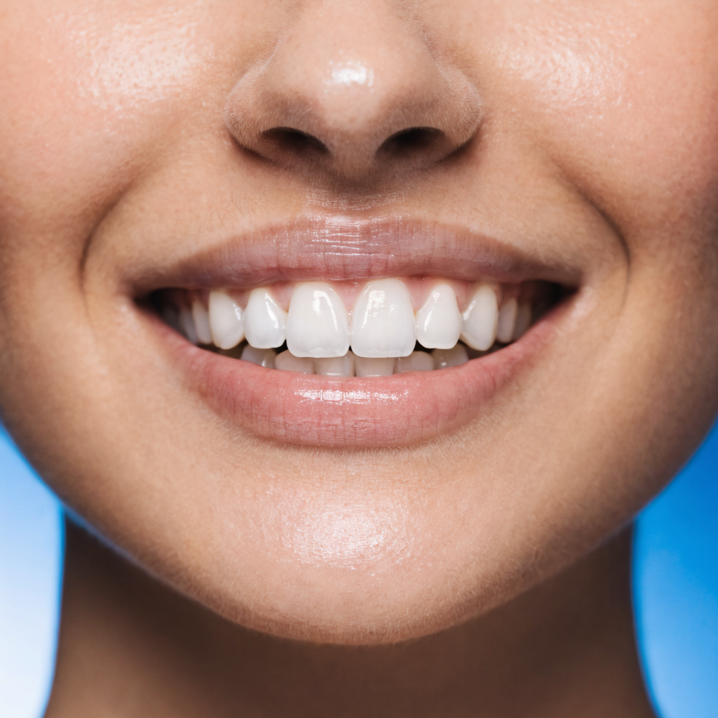 Blanqueamiento dental profesional antes y después